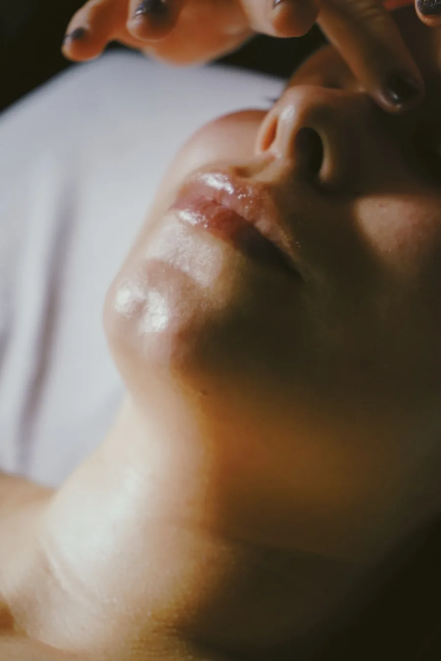 Rosacea